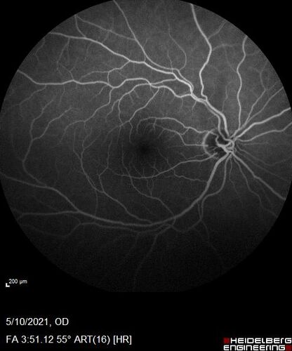 Branch Retinal Vein Occlusion with Neovascularization Elsewhere and Vitreous Hemorrhage
57 year old man New floaters in the left eye about a month ago.  Now they are getting better.  PMHx A-Fib on Pradaxa
VA 20/32 OD, 20/40 OS
1+ NS OU
BP 137/77, 200LBs, 5â€™8â€

PRP laser was done
