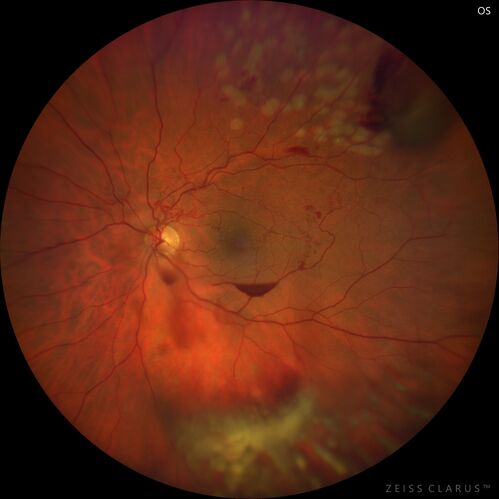 Branch Retinal Vein Occlusion with Neovascularization Elsewhere and Vitreous Hemorrhage
57 year old man New floaters in the left eye about a month ago.  Now they are getting better.  PMHx A-Fib on Pradaxa
VA 20/32 OD, 20/40 OS
1+ NS OU
BP 137/77, 200LBs, 5â€™8â€

PRP laser was done
