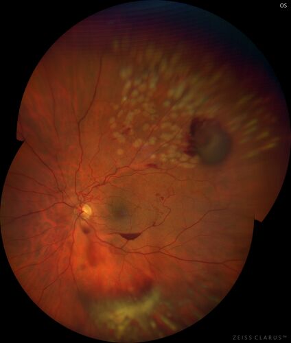 Branch Retinal Vein Occlusion with Neovascularization Elsewhere and Vitreous Hemorrhage
57 year old man New floaters in the left eye about a month ago.  Now they are getting better.  PMHx A-Fib on Pradaxa
VA 20/32 OD, 20/40 OS
1+ NS OU
BP 137/77, 200LBs, 5â€™8â€

PRP laser was done
