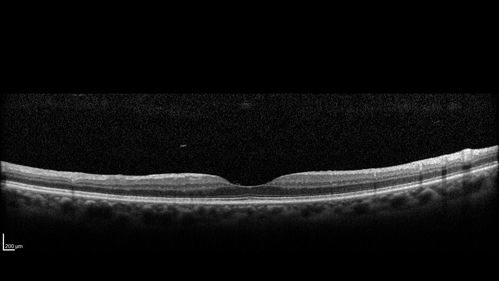 Acute Branch Retinal Vein Occlusion - 20/200
66 year old female with 3 weeks of vision loss in the left eye.  VA 20/20 OD 20/200 OS
