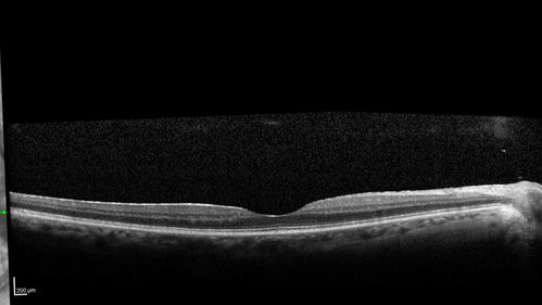 Acute Branch Retinal Vein Occlusion - 20/200
66 year old female with 3 weeks of vision loss in the left eye.  VA 20/20 OD 20/200 OS
