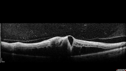 Acute Branch Retinal Vein Occlusion - 20/200
66 year old female with 3 weeks of vision loss in the left eye.  VA 20/20 OD 20/200 OS
