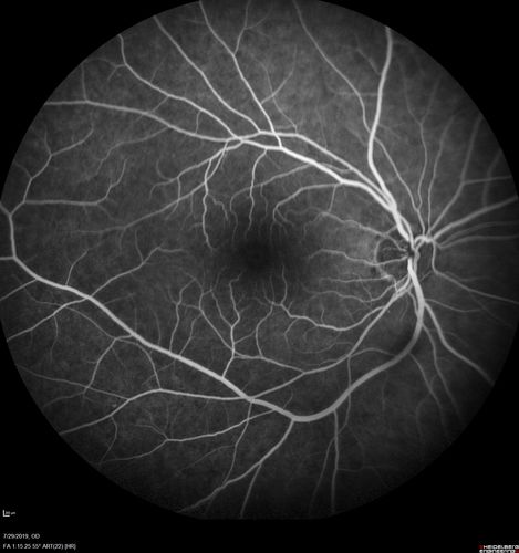 Acute Branch Retinal Vein Occlusion - 20/200
66 year old female with 3 weeks of vision loss in the left eye.  VA 20/20 OD 20/200 OS
