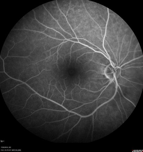 Acute Branch Retinal Vein Occlusion - 20/200
66 year old female with 3 weeks of vision loss in the left eye.  VA 20/20 OD 20/200 OS
