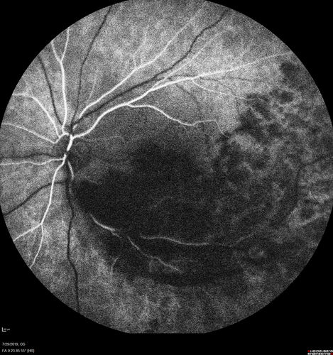 Acute Branch Retinal Vein Occlusion - 20/200
66 year old female with 3 weeks of vision loss in the left eye.  VA 20/20 OD 20/200 OS

