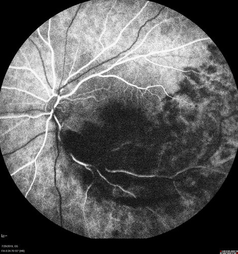 Acute Branch Retinal Vein Occlusion - 20/200
66 year old female with 3 weeks of vision loss in the left eye.  VA 20/20 OD 20/200 OS
