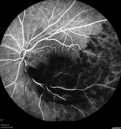 Acute Branch Retinal Vein Occlusion - 20/200
66 year old female with 3 weeks of vision loss in the left eye.  VA 20/20 OD 20/200 OS
