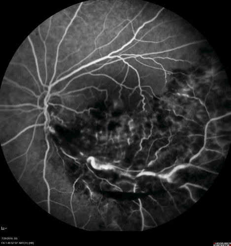 Acute Branch Retinal Vein Occlusion - 20/200
66 year old female with 3 weeks of vision loss in the left eye.  VA 20/20 OD 20/200 OS
