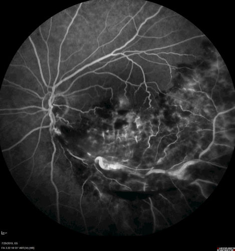 Acute Branch Retinal Vein Occlusion - 20/200
66 year old female with 3 weeks of vision loss in the left eye.  VA 20/20 OD 20/200 OS
