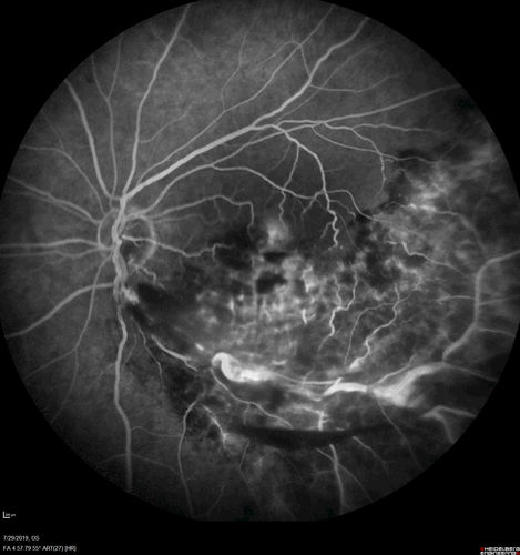 Acute Branch Retinal Vein Occlusion - 20/200
66 year old female with 3 weeks of vision loss in the left eye.  VA 20/20 OD 20/200 OS
