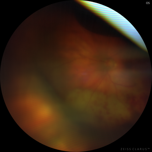 Scleral Buckle Intrusion
85 year old woman with 35 year old scleral buckle in the left eye.  Her vision has been gradually declining with increasing uveitis and finally a scleral buckle intrusion.  Over about 18 months the eye became painful with NLP vision and ultimately was removed.
