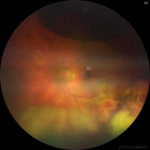 Scleral Buckle Intrusion
85 year old woman with 35 year old scleral buckle in the left eye.  Her vision has been gradually declining with increasing uveitis and finally a scleral buckle intrusion.  Over about 18 months the eye became painful with NLP vision and ultimately was removed.
