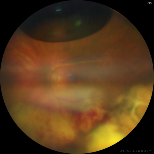 Scleral Buckle Intrusion
85 year old woman with 35 year old scleral buckle in the left eye.  Her vision has been gradually declining with increasing uveitis and finally a scleral buckle intrusion.  Over about 18 months the eye became painful with NLP vision and ultimately was removed.
