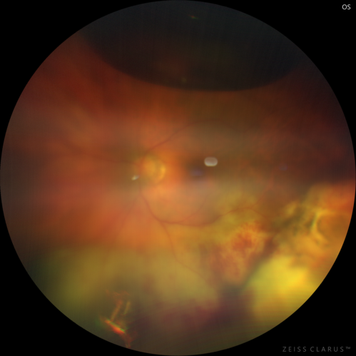 Scleral Buckle Intrusion
85 year old woman with 35 year old scleral buckle in the left eye.  Her vision has been gradually declining with increasing uveitis and finally a scleral buckle intrusion.  Over about 18 months the eye became painful with NLP vision and ultimately was removed.
