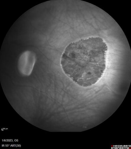 32 year old female with normal vision and CHRPE
