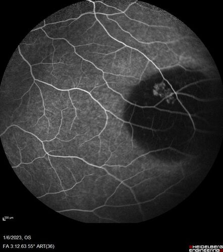 32 year old female with normal vision and CHRPE
