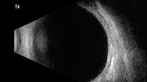 32 year old female with normal vision and CHRPE
