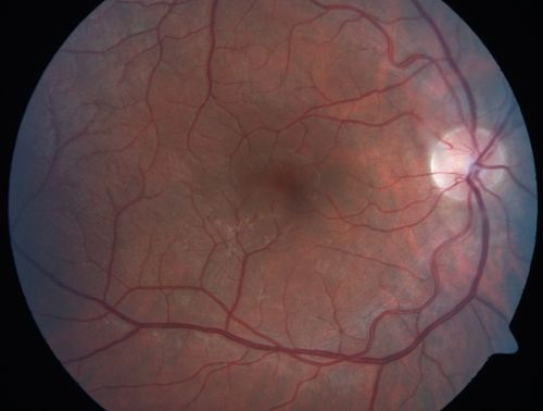 Congenital Hypertrophy of the Retinal Pigment Epithelium CHRPE has Satellite Lesions

