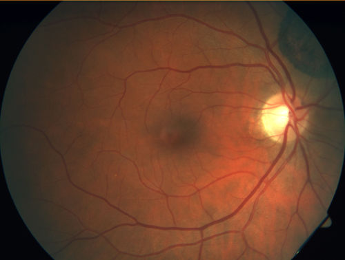 Congenital Hypetrophy of the Retinal Pigment Epithelium (CHRPE)
63 year old female with normal vision and CHRPE lesion in the right eye.
