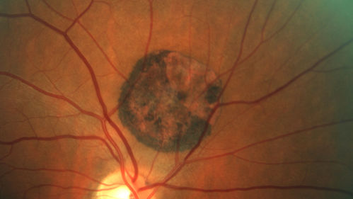 Congenital Hypetrophy of the Retinal Pigment Epithelium (CHRPE)
63 year old female with normal vision and CHRPE lesion in the right eye.
