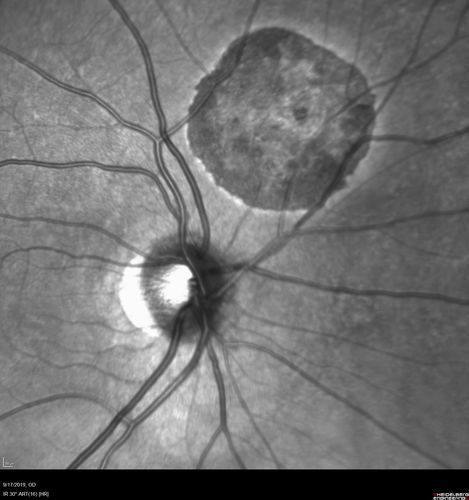 Congenital Hypetrophy of the Retinal Pigment Epithelium (CHRPE)
63 year old female with normal vision and CHRPE lesion in the right eye.
