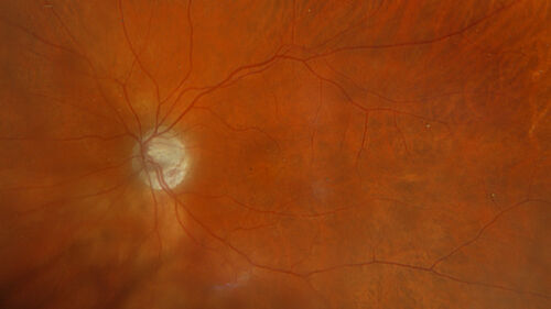 Latanoprost induced CME
89 year old man with CME from latanoprost that cleared within one month of stopping the medication
