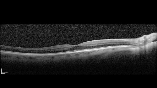 Latanoprost induced CME
89 year old man with CME from latanoprost that cleared within one month of stopping the medication
