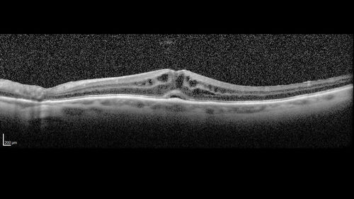 Latanoprost induced CME
89 year old man with CME from latanoprost that cleared within one month of stopping the medication
