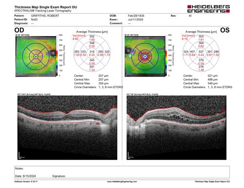 Latanoprost induced CME
89 year old man with CME from latanoprost that cleared within one month of stopping the medication
