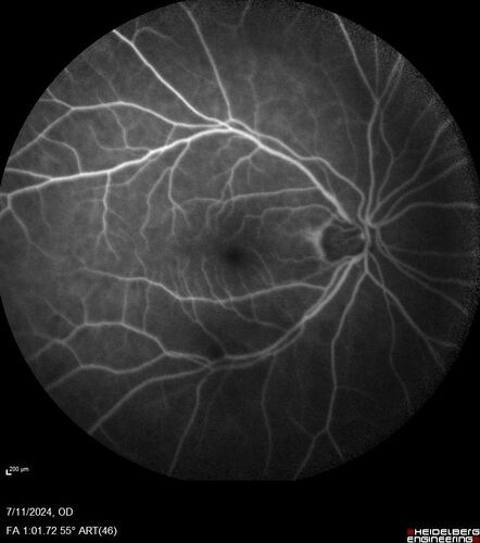 Latanoprost induced CME
89 year old man with CME from latanoprost that cleared within one month of stopping the medication
