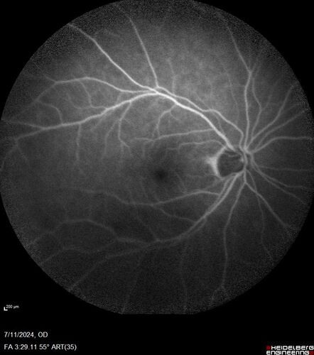 Latanoprost induced CME
89 year old man with CME from latanoprost that cleared within one month of stopping the medication
