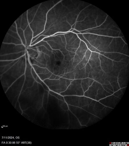 Latanoprost induced CME
89 year old man with CME from latanoprost that cleared within one month of stopping the medication
