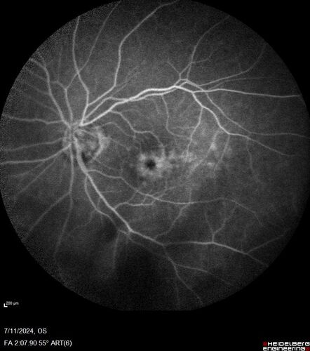Latanoprost induced CME
89 year old man with CME from latanoprost that cleared within one month of stopping the medication
