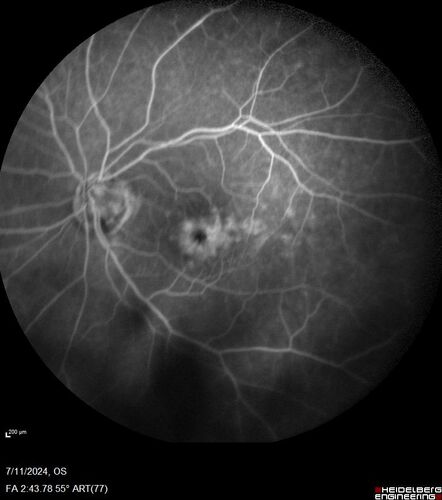 Latanoprost induced CME
89 year old man with CME from latanoprost that cleared within one month of stopping the medication
