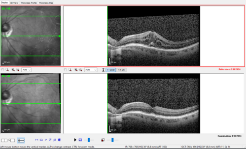 Latanoprost induced CME
89 year old man with CME from latanoprost that cleared within one month of stopping the medication
