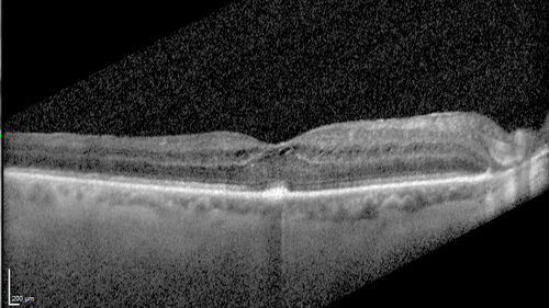 Paclitaxel induced cystoid macular edema - reversed when chemo stopped
74 year old retired physician  About 2-3 weeks ago there was gradual vision loss in the right eye. The patient was seen by an ophthalmologist who saw macular swelling and injected vabysmo. He has been on chemotherapy (Carbiplatin and Carboxytaxol for 2 cancers - advanced prostrate diagnosed 2019 - has had brain surgery AND squamous lung cancers treated with radiation)
Medical Hx: Prostate cancer (Onset: 2018). Pulmonary and bone cancer metastatic. Brain cancer metastasized from prostate cancer. 
Surgical Hx: Right frontal & Frontoparietal Craniotomy (Onset: 2024). Appendectomy. Hemorrhoidectomy. Herniorrhaphy. Prostate. Systemic Meds: Chemotherapy. Radiation. Eligard Every 3 Months 22.5 MG per 0.375 ML Prefilled Syringe. MIRALAX prn. Tums Freshers 500 MG Chewable Tablet. Vitamin D. XGEVA. 
VA OD: Dcc20/125+1 
VA OS: Dcc20/125-2 
TP: OD:12 OS:15
