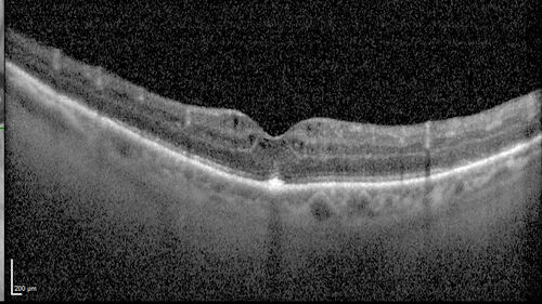 Paclitaxel induced cystoid macular edema - reversed when chemo stopped
74 year old retired physician  About 2-3 weeks ago there was gradual vision loss in the right eye. The patient was seen by an ophthalmologist who saw macular swelling and injected vabysmo. He has been on chemotherapy (Carbiplatin and Carboxytaxol for 2 cancers - advanced prostrate diagnosed 2019 - has had brain surgery AND squamous lung cancers treated with radiation)
Medical Hx: Prostate cancer (Onset: 2018). Pulmonary and bone cancer metastatic. Brain cancer metastasized from prostate cancer. 
Surgical Hx: Right frontal & Frontoparietal Craniotomy (Onset: 2024). Appendectomy. Hemorrhoidectomy. Herniorrhaphy. Prostate. Systemic Meds: Chemotherapy. Radiation. Eligard Every 3 Months 22.5 MG per 0.375 ML Prefilled Syringe. MIRALAX prn. Tums Freshers 500 MG Chewable Tablet. Vitamin D. XGEVA. 
VA OD: Dcc20/125+1 
VA OS: Dcc20/125-2 
TP: OD:12 OS:15
