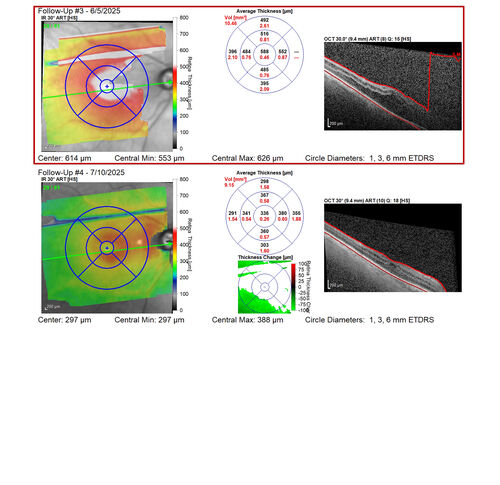 Paclitaxel induced cystoid macular edema - reversed when chemo stopped
74 year old retired physician  About 2-3 weeks ago there was gradual vision loss in the right eye. The patient was seen by an ophthalmologist who saw macular swelling and injected vabysmo. He has been on chemotherapy (Carbiplatin and Carboxytaxol for 2 cancers - advanced prostrate diagnosed 2019 - has had brain surgery AND squamous lung cancers treated with radiation)
Medical Hx: Prostate cancer (Onset: 2018). Pulmonary and bone cancer metastatic. Brain cancer metastasized from prostate cancer. 
Surgical Hx: Right frontal & Frontoparietal Craniotomy (Onset: 2024). Appendectomy. Hemorrhoidectomy. Herniorrhaphy. Prostate. Systemic Meds: Chemotherapy. Radiation. Eligard Every 3 Months 22.5 MG per 0.375 ML Prefilled Syringe. MIRALAX prn. Tums Freshers 500 MG Chewable Tablet. Vitamin D. XGEVA. 
VA OD: Dcc20/125+1 
VA OS: Dcc20/125-2 
TP: OD:12 OS:15
