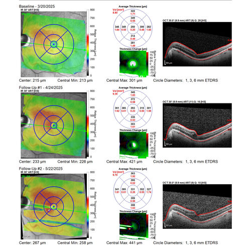 Paclitaxel induced cystoid macular edema - reversed when chemo stopped
74 year old retired physician  About 2-3 weeks ago there was gradual vision loss in the right eye. The patient was seen by an ophthalmologist who saw macular swelling and injected vabysmo. He has been on chemotherapy (Carbiplatin and Carboxytaxol for 2 cancers - advanced prostrate diagnosed 2019 - has had brain surgery AND squamous lung cancers treated with radiation)
Medical Hx: Prostate cancer (Onset: 2018). Pulmonary and bone cancer metastatic. Brain cancer metastasized from prostate cancer. 
Surgical Hx: Right frontal & Frontoparietal Craniotomy (Onset: 2024). Appendectomy. Hemorrhoidectomy. Herniorrhaphy. Prostate. Systemic Meds: Chemotherapy. Radiation. Eligard Every 3 Months 22.5 MG per 0.375 ML Prefilled Syringe. MIRALAX prn. Tums Freshers 500 MG Chewable Tablet. Vitamin D. XGEVA. 
VA OD: Dcc20/125+1 
VA OS: Dcc20/125-2 
TP: OD:12 OS:15
