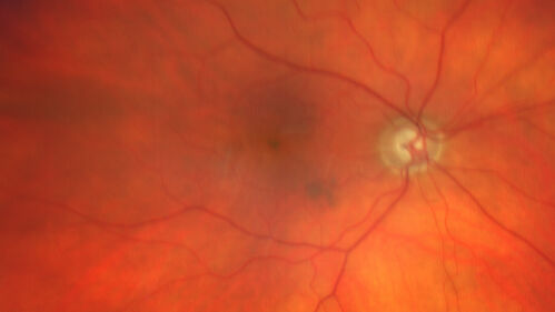 Paclitaxel induced cystoid macular edema - reversed when chemo stopped
74 year old retired physician  About 2-3 weeks ago there was gradual vision loss in the right eye. The patient was seen by an ophthalmologist who saw macular swelling and injected vabysmo. He has been on chemotherapy (Carbiplatin and Carboxytaxol for 2 cancers - advanced prostrate diagnosed 2019 - has had brain surgery AND squamous lung cancers treated with radiation)
Medical Hx: Prostate cancer (Onset: 2018). Pulmonary and bone cancer metastatic. Brain cancer metastasized from prostate cancer. 
Surgical Hx: Right frontal & Frontoparietal Craniotomy (Onset: 2024). Appendectomy. Hemorrhoidectomy. Herniorrhaphy. Prostate. Systemic Meds: Chemotherapy. Radiation. Eligard Every 3 Months 22.5 MG per 0.375 ML Prefilled Syringe. MIRALAX prn. Tums Freshers 500 MG Chewable Tablet. Vitamin D. XGEVA. 
VA OD: Dcc20/125+1 
VA OS: Dcc20/125-2 
TP: OD:12 OS:15
