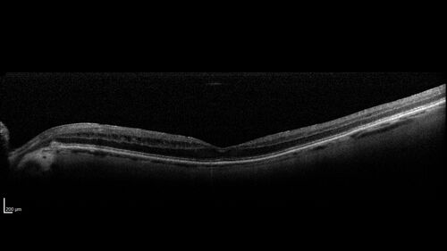 Paclitaxel induced cystoid macular edema - reversed when chemo stopped
74 year old retired physician  About 2-3 weeks ago there was gradual vision loss in the right eye. The patient was seen by an ophthalmologist who saw macular swelling and injected vabysmo. He has been on chemotherapy (Carbiplatin and Carboxytaxol for 2 cancers - advanced prostrate diagnosed 2019 - has had brain surgery AND squamous lung cancers treated with radiation)
Medical Hx: Prostate cancer (Onset: 2018). Pulmonary and bone cancer metastatic. Brain cancer metastasized from prostate cancer. 
Surgical Hx: Right frontal & Frontoparietal Craniotomy (Onset: 2024). Appendectomy. Hemorrhoidectomy. Herniorrhaphy. Prostate. Systemic Meds: Chemotherapy. Radiation. Eligard Every 3 Months 22.5 MG per 0.375 ML Prefilled Syringe. MIRALAX prn. Tums Freshers 500 MG Chewable Tablet. Vitamin D. XGEVA. 
VA OD: Dcc20/125+1 
VA OS: Dcc20/125-2 
TP: OD:12 OS:15
