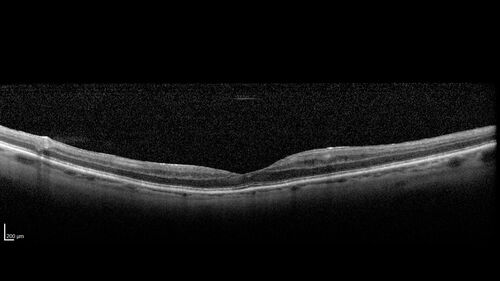 Paclitaxel induced cystoid macular edema - reversed when chemo stopped
74 year old retired physician  About 2-3 weeks ago there was gradual vision loss in the right eye. The patient was seen by an ophthalmologist who saw macular swelling and injected vabysmo. He has been on chemotherapy (Carbiplatin and Carboxytaxol for 2 cancers - advanced prostrate diagnosed 2019 - has had brain surgery AND squamous lung cancers treated with radiation)
Medical Hx: Prostate cancer (Onset: 2018). Pulmonary and bone cancer metastatic. Brain cancer metastasized from prostate cancer. 
Surgical Hx: Right frontal & Frontoparietal Craniotomy (Onset: 2024). Appendectomy. Hemorrhoidectomy. Herniorrhaphy. Prostate. Systemic Meds: Chemotherapy. Radiation. Eligard Every 3 Months 22.5 MG per 0.375 ML Prefilled Syringe. MIRALAX prn. Tums Freshers 500 MG Chewable Tablet. Vitamin D. XGEVA. 
VA OD: Dcc20/125+1 
VA OS: Dcc20/125-2 
TP: OD:12 OS:15
