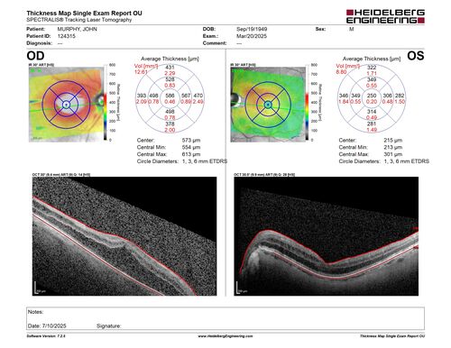 Paclitaxel induced cystoid macular edema - reversed when chemo stopped
74 year old retired physician  About 2-3 weeks ago there was gradual vision loss in the right eye. The patient was seen by an ophthalmologist who saw macular swelling and injected vabysmo. He has been on chemotherapy (Carbiplatin and Carboxytaxol for 2 cancers - advanced prostrate diagnosed 2019 - has had brain surgery AND squamous lung cancers treated with radiation)
Medical Hx: Prostate cancer (Onset: 2018). Pulmonary and bone cancer metastatic. Brain cancer metastasized from prostate cancer. 
Surgical Hx: Right frontal & Frontoparietal Craniotomy (Onset: 2024). Appendectomy. Hemorrhoidectomy. Herniorrhaphy. Prostate. Systemic Meds: Chemotherapy. Radiation. Eligard Every 3 Months 22.5 MG per 0.375 ML Prefilled Syringe. MIRALAX prn. Tums Freshers 500 MG Chewable Tablet. Vitamin D. XGEVA. 
VA OD: Dcc20/125+1 
VA OS: Dcc20/125-2 
TP: OD:12 OS:15
