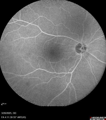 Paclitaxel induced cystoid macular edema - reversed when chemo stopped
74 year old retired physician  About 2-3 weeks ago there was gradual vision loss in the right eye. The patient was seen by an ophthalmologist who saw macular swelling and injected vabysmo. He has been on chemotherapy (Carbiplatin and Carboxytaxol for 2 cancers - advanced prostrate diagnosed 2019 - has had brain surgery AND squamous lung cancers treated with radiation)
Medical Hx: Prostate cancer (Onset: 2018). Pulmonary and bone cancer metastatic. Brain cancer metastasized from prostate cancer. 
Surgical Hx: Right frontal & Frontoparietal Craniotomy (Onset: 2024). Appendectomy. Hemorrhoidectomy. Herniorrhaphy. Prostate. Systemic Meds: Chemotherapy. Radiation. Eligard Every 3 Months 22.5 MG per 0.375 ML Prefilled Syringe. MIRALAX prn. Tums Freshers 500 MG Chewable Tablet. Vitamin D. XGEVA. 
VA OD: Dcc20/125+1 
VA OS: Dcc20/125-2 
TP: OD:12 OS:15
