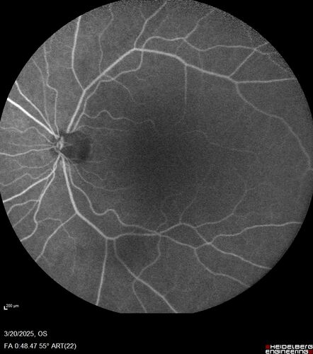 Paclitaxel induced cystoid macular edema - reversed when chemo stopped
74 year old retired physician  About 2-3 weeks ago there was gradual vision loss in the right eye. The patient was seen by an ophthalmologist who saw macular swelling and injected vabysmo. He has been on chemotherapy (Carbiplatin and Carboxytaxol for 2 cancers - advanced prostrate diagnosed 2019 - has had brain surgery AND squamous lung cancers treated with radiation)
Medical Hx: Prostate cancer (Onset: 2018). Pulmonary and bone cancer metastatic. Brain cancer metastasized from prostate cancer. 
Surgical Hx: Right frontal & Frontoparietal Craniotomy (Onset: 2024). Appendectomy. Hemorrhoidectomy. Herniorrhaphy. Prostate. Systemic Meds: Chemotherapy. Radiation. Eligard Every 3 Months 22.5 MG per 0.375 ML Prefilled Syringe. MIRALAX prn. Tums Freshers 500 MG Chewable Tablet. Vitamin D. XGEVA. 
VA OD: Dcc20/125+1 
VA OS: Dcc20/125-2 
TP: OD:12 OS:15
