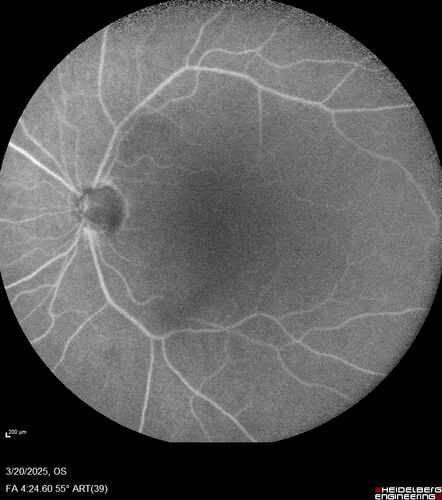 Paclitaxel induced cystoid macular edema - reversed when chemo stopped
74 year old retired physician  About 2-3 weeks ago there was gradual vision loss in the right eye. The patient was seen by an ophthalmologist who saw macular swelling and injected vabysmo. He has been on chemotherapy (Carbiplatin and Carboxytaxol for 2 cancers - advanced prostrate diagnosed 2019 - has had brain surgery AND squamous lung cancers treated with radiation)
Medical Hx: Prostate cancer (Onset: 2018). Pulmonary and bone cancer metastatic. Brain cancer metastasized from prostate cancer. 
Surgical Hx: Right frontal & Frontoparietal Craniotomy (Onset: 2024). Appendectomy. Hemorrhoidectomy. Herniorrhaphy. Prostate. Systemic Meds: Chemotherapy. Radiation. Eligard Every 3 Months 22.5 MG per 0.375 ML Prefilled Syringe. MIRALAX prn. Tums Freshers 500 MG Chewable Tablet. Vitamin D. XGEVA. 
VA OD: Dcc20/125+1 
VA OS: Dcc20/125-2 
TP: OD:12 OS:15
