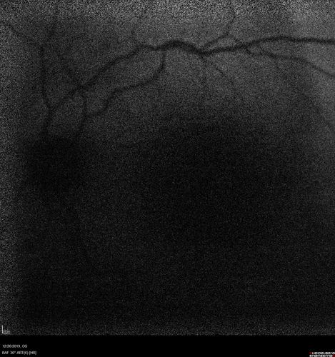 Cystoid Macular Edema and Macular Pucker
has been particular bad for 3 years.  She has a macular pucker and severe CME.

VA 20/160 left eye
