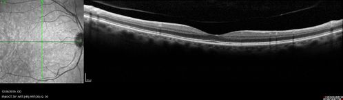 Normal Eye - Vision 20/16
61 year old female with multiple problems including chronic CME in the left eye.
