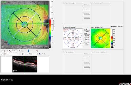 Normal Eye - Vision 20/16
61 year old female with multiple problems including chronic CME in the left eye.
