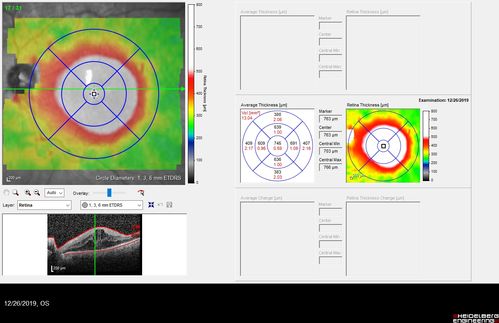 Cystoid Macular Edema and Macular Pucker
has been particular bad for 3 years.  She has a macular pucker and severe CME.

VA 20/160 left eye
